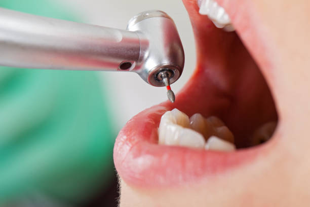 Best Emergency Wisdom Teeth Removal in Sylvan Lake, MI